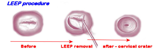 hpv virus and leep procedure